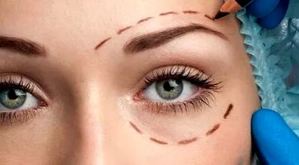 blepharoplasty