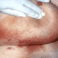 candidiasis