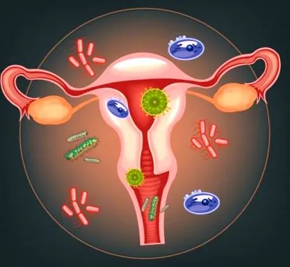 hüvelyi candidiasis