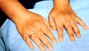 arthritis arthritis