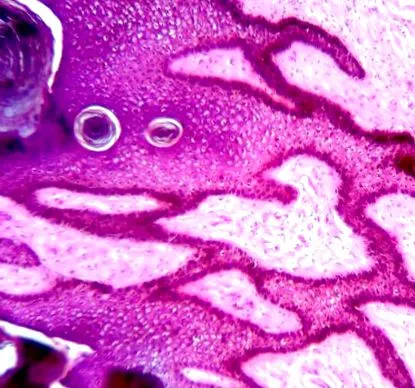 condyloma