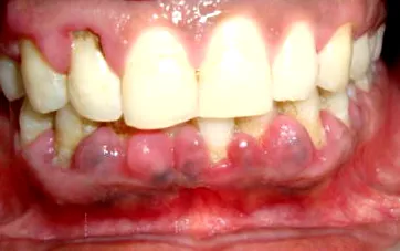 papilloma