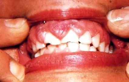 gingiva