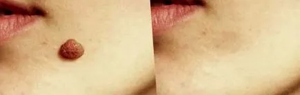 papilloma testen