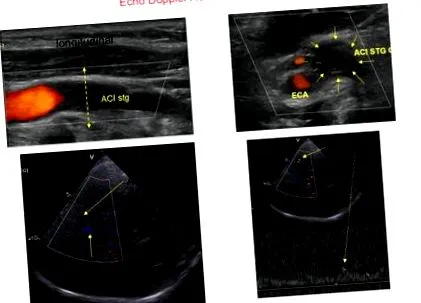 doppler ultrahang