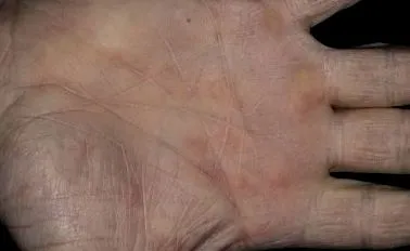 erythema testen