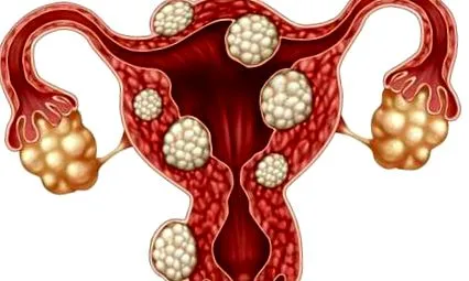 fibroidov maternice