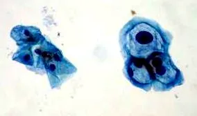 papilloma
