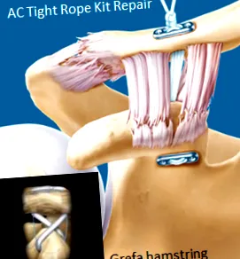 acromio-clavicularis diszjunkció