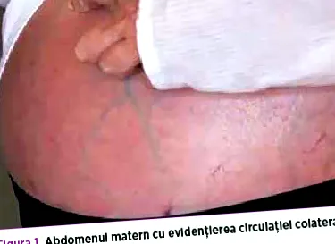 komplikovaného