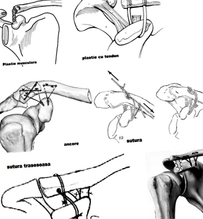 acromio-clavicularis acromio-clavicularis