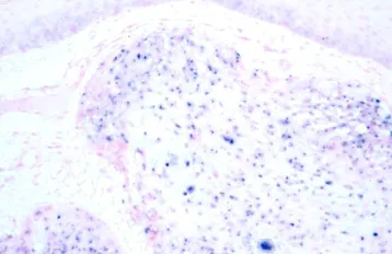 papilloma