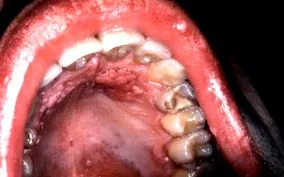 papilloma vírus torokrák férfiaknál