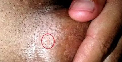condyloma férfi