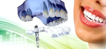 után implantátum