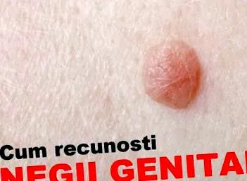 hpv-fertőzés