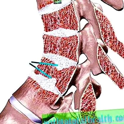 osteochondrosis