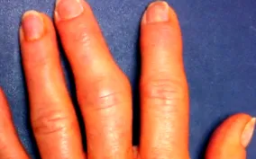 osteoarthritis kezelésére