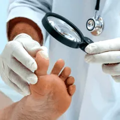 onychomycosis