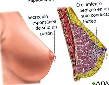 causas