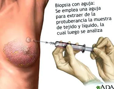 intraductalis