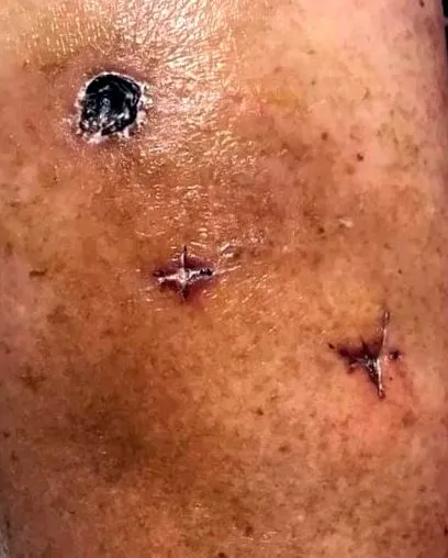 állapot hematoma