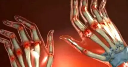 osteoarthritis esetén