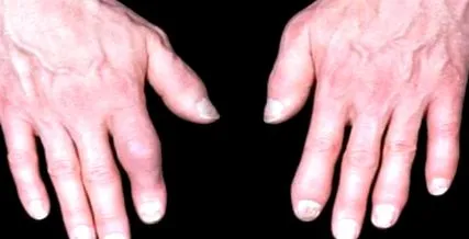 rheumatoid könyökízületek