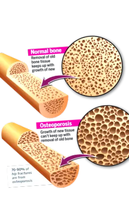 osteopenia