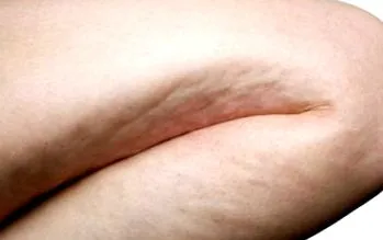 cellulit