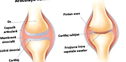 arthritis
