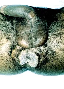 papilloma etiológiája
