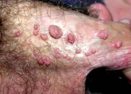 papilloma gyomorrák