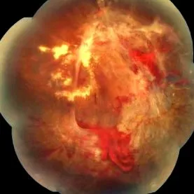 retinopathia kezelés