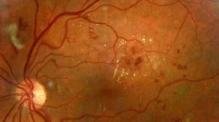 retinopathia kezelés