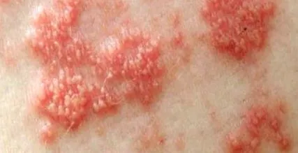 varicella-zoster vírus