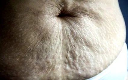 moduri pielea