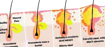 preț acne