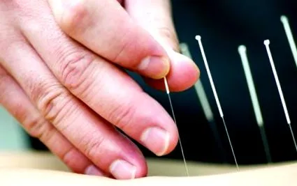 acupunctura acupunctura
