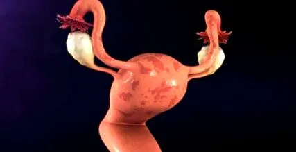 endometrioza