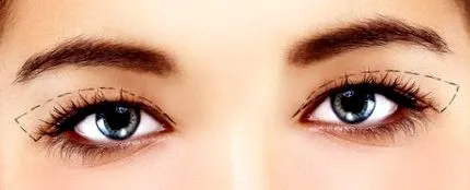 blefaroplastie