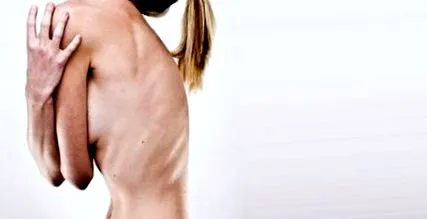 anorexice sperie