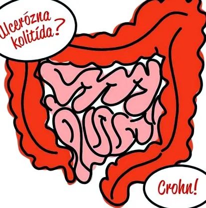 idiopatică intestinală