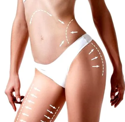 liposucția laser