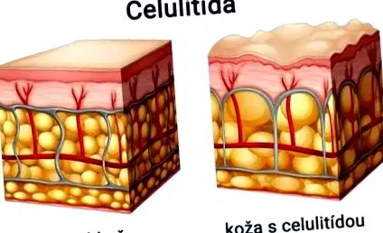 celulită