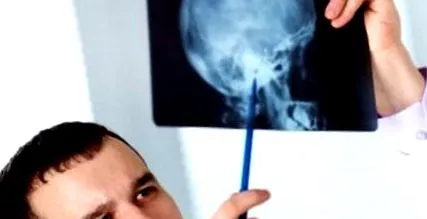 cancerului cerebral