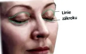 chirurgie Chirurgia pleoapelor