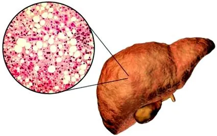 hepatică