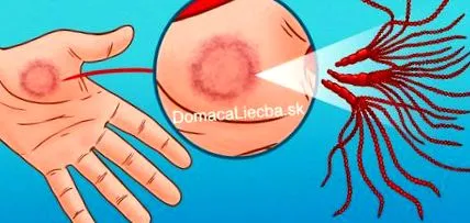 mycosisára