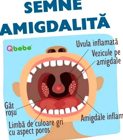 mandulagyulladás